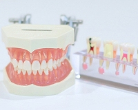 精密義歯について